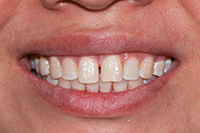 iSmile Dental Group | Dental Bridges, Night Guards and Root Canals