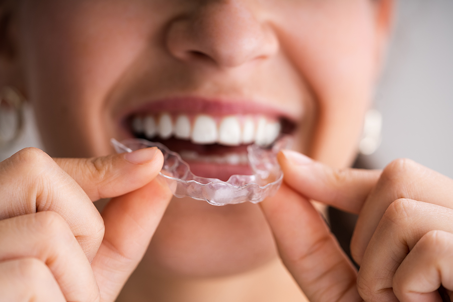 Clear Aligners