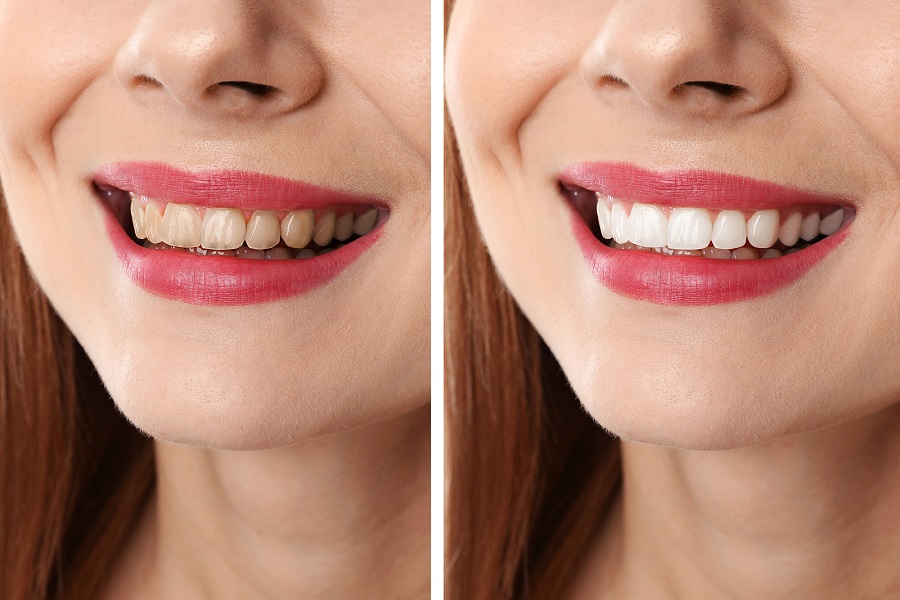 What You Should Know About Teeth Whitening Strips