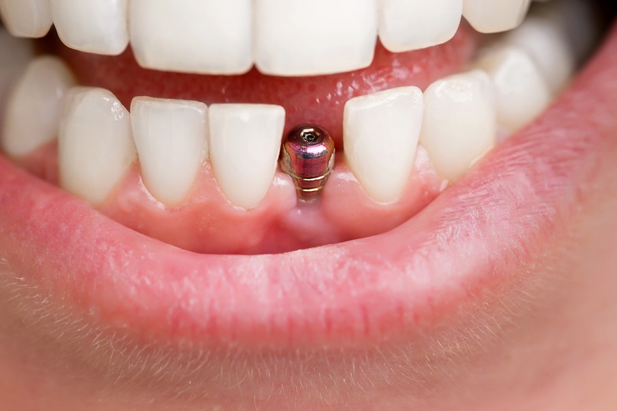 The Ultimate Guide to Dental Implant Surgery