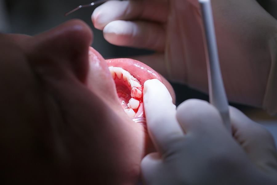 Comprehensive Insights into Periodontal Disease and Its Effective Treatments